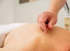 Athletes acupuncture recovery methods